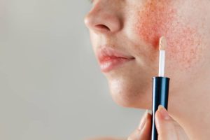 tipos de rosacea