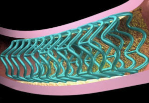 stent que es