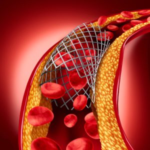 que es un stent y para que sirve