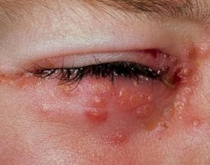 Cómo curar la culebrilla síntomas y tratamiento