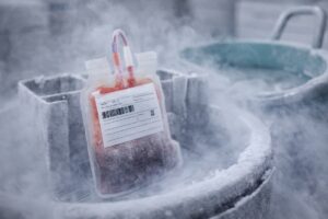 Bolsa criopreservada con c&eacute;lulas madre del cord&oacute;n umbilical almacenada en nitr&oacute;geno l&iacute;quido